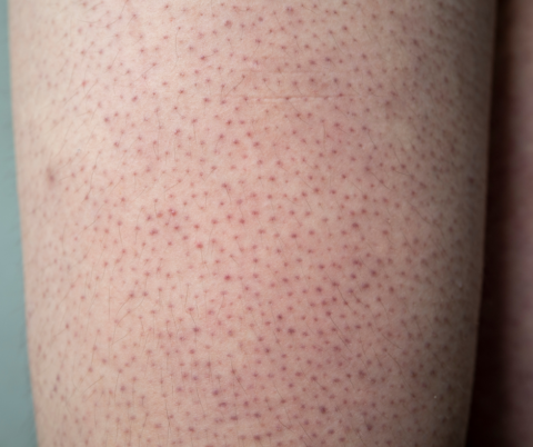 Banish Keratosis Pilaris: Your Path to Smooth and Radiant Skin | Lake